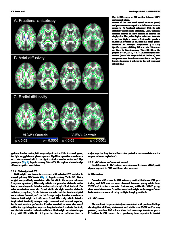 Download Altered grey matter volume, perfusion and white matter integrity in very low birthweight adults.