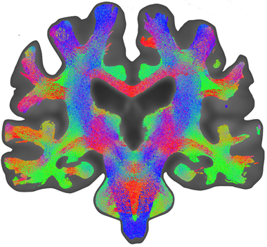 Diffusion MRI