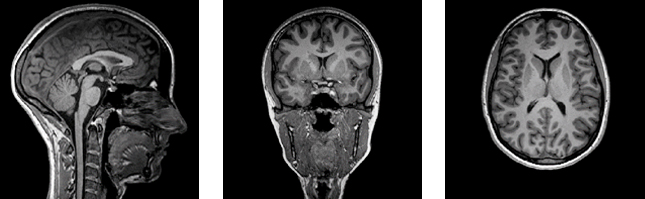 Structural MRI side view, front view, top view