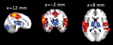 FMRI BOLD changes during microsleeps: deactivations (blue) and activations (red).   [Poudel et al., Hum Brain Mapp, 2014]