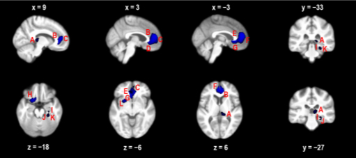 Decreased regional perfusion (blue areas) when awake in participants with moderate-severe OSA compared with controls.  [Innes et al., Sleep, 2015]