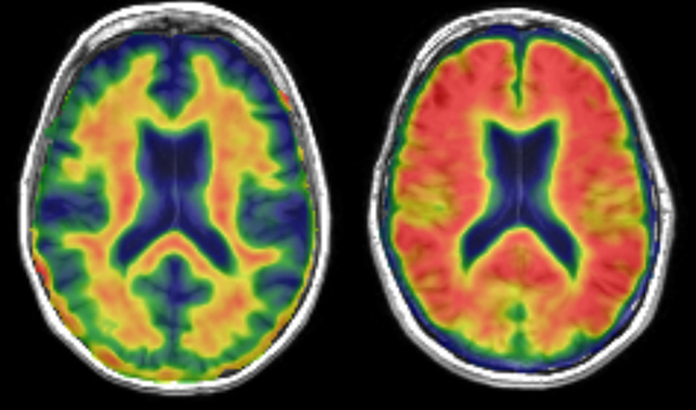 Amyloid PET comparison