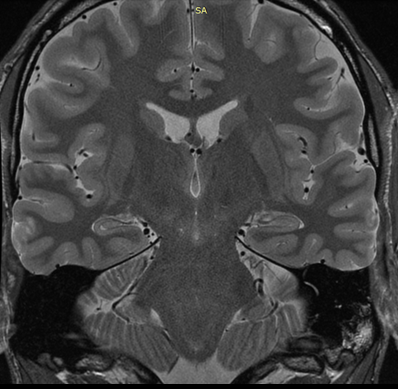 PD-weighted temporal image