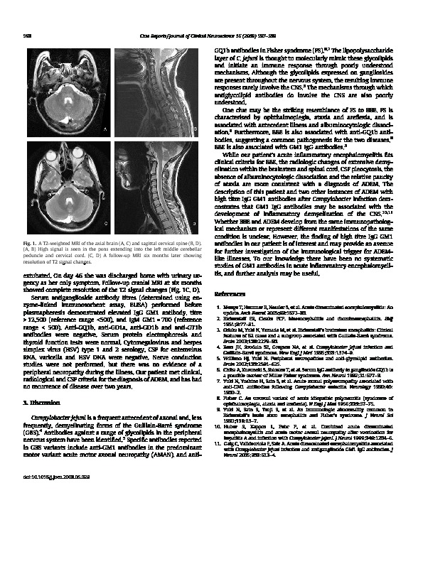 Download Acute inflammatory encephalomyelitis following Campylobacter enteritis associated with high titre antiganglioside GM1 IgG antibodies.