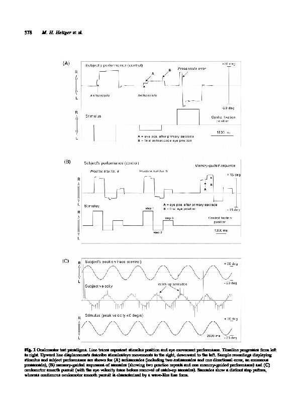 Download Eye movement and visuomotor arm movement deficits following mild closed head injury.