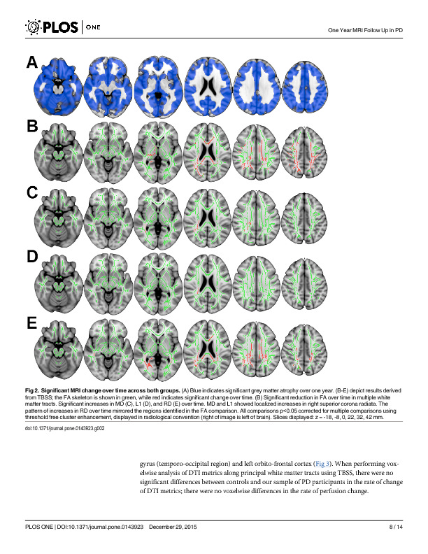 Download Tracking Parkinson's disease over one year with multimodal magnetic resonance imaging in a group of older patients with moderate disease.