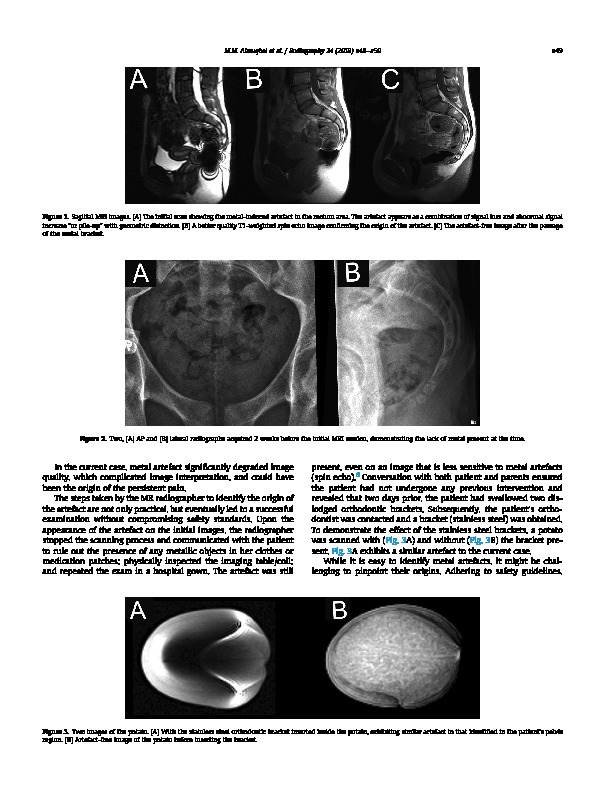 Download  MRI artefact in the rectum caused by ingested orthodontic brackets.