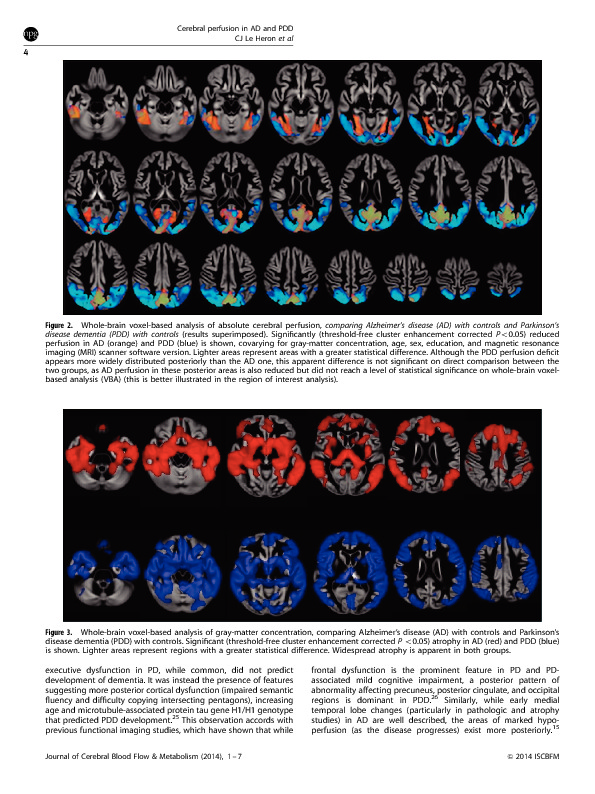 Download Comparing cerebral perfusion in Alzheimer's disease and Parkinson's disease dementia: an ASL-MRI study.