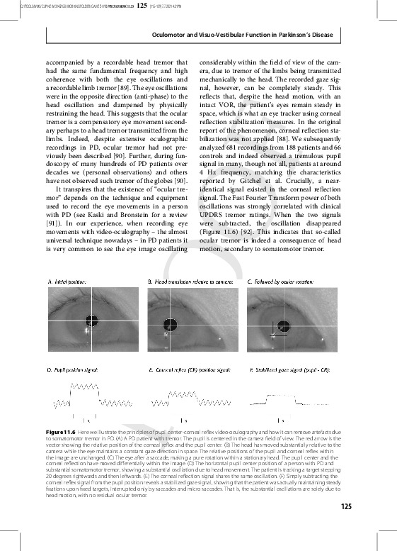 Download Oculomotor and visuo-vestibular function in Parkinson’s disease. In N. Gálvez-Jiménez, A. D. Korczyn, & R. Lugo-Sanchez (Eds).