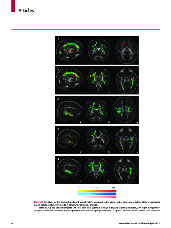 Download Effect of antenatal magnesium sulphate on MRI biomarkers of white matter development at term equivalent age: the MagNUM Study.