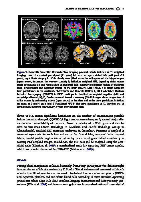 Download Dementia Prevention Research Clinic: A longitudinal study investigating factors influencing the development of Alzheimer’s disease in Aotearoa.