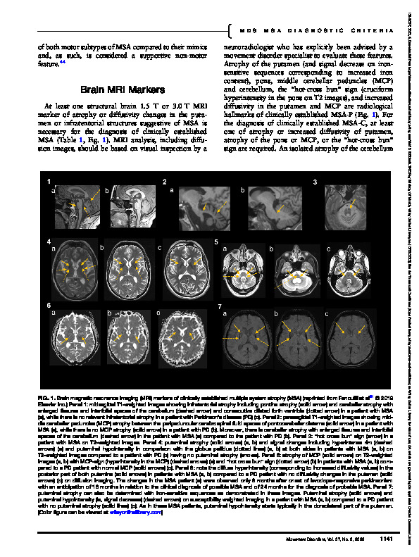 Download The movement disorder society criteria for the diagnosis of multiple system atrophy.