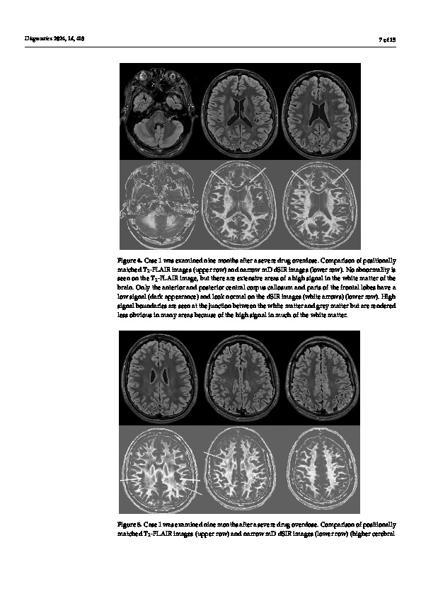 Download Diagnosis of Delayed Post-Hypoxic Leukoencephalopathy (Grinker’s Myelinopathy) with MRI Using Divided Subtracted Inversion Recovery (dSIR) Sequences: Time for Reappraisal of the Syndrome?