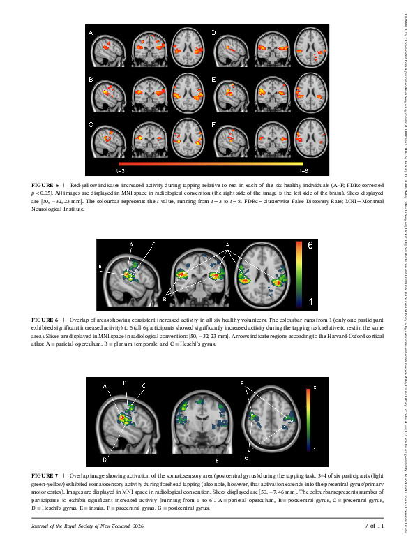Download Midline Head Tap to Image the Human Vestibular Cortex on fMRI.