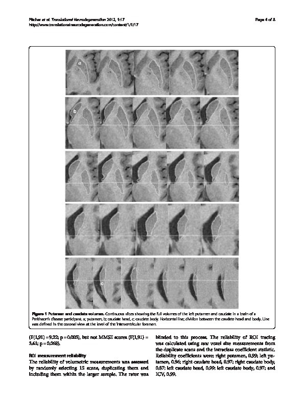 Download Reduced striatal volumes in Parkinson’s disease: a magnetic resonance imaging study.